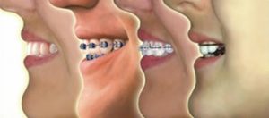 ortodoncia-madrid